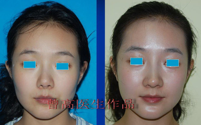 北京中日友好曾高隆鼻案例图