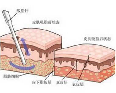吸脂减肥原理