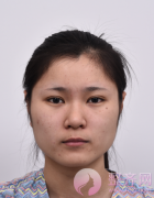 下颌角磨骨、硅胶隆鼻术后3个月案例 下颌角磨骨、硅胶隆鼻术后3个月案例