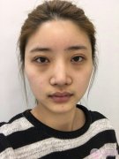 双眼皮修复、自体脂肪面部填充案例 双眼皮修复、自体脂肪面部填充案例