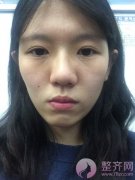 鼻中隔软骨隆鼻,脂肪填充术后8个月 鼻中隔软骨隆鼻,脂肪填充术后8个月