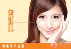 自体脂肪丰苹果机,让你笑的更自然、更迷人! 自体脂肪丰苹果机,让你笑的更自然、更迷人!