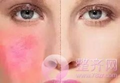 脸部红血丝泛滥应该怎么改善? 脸部红血丝泛滥应该怎么改善?