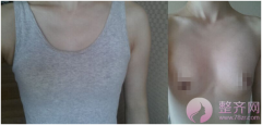 水滴型丰胸手术术后4个月 水滴型丰胸手术术后4个月
