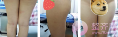 大腿吸脂3个月案例 大腿吸脂3个月案例