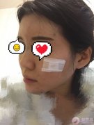 自体脂肪填充全脸术后案例 自体脂肪填充全脸术后案例