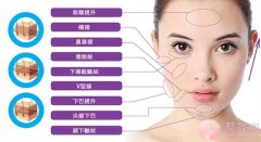 什么是悬吊抗衰术? 什么是悬吊抗衰术?