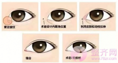 【为什么有的人会被建议开眼角?】 【为什么有的人会被建议开眼角?】