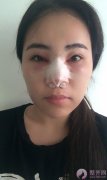 鼻部综合案例分享 鼻部综合案例分享