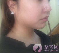 面部吸脂术后案例 面部吸脂术后案例