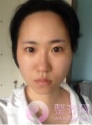 面部轮廓整形手术案例 面部轮廓整形手术案例