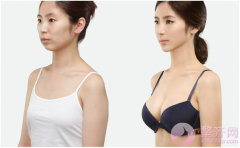 水滴型丰胸整形案例 水滴型丰胸整形案例