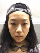 脂肪填充,埋线双眼皮,开前眼角手术 脂肪填充,埋线双眼皮,开前眼角手术