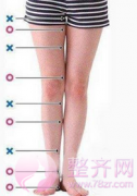 【x型腿和o型腿矫正方法】 【x型腿和o型腿矫正方法】