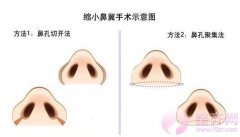 改变鼻翼需要注意什么问题? 改变鼻翼需要注意什么问题?