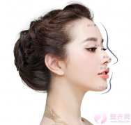 假体隆鼻之后会透光吗? 假体隆鼻之后会透光吗?