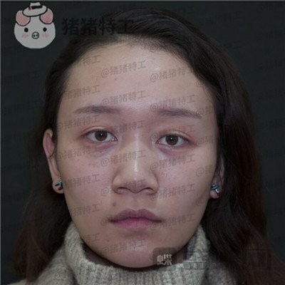 贵阳华美,黄在弘,面部填充,案例,价格,