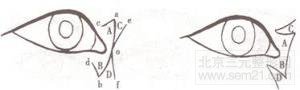内眦开大术