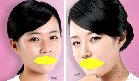 隆鼻案例