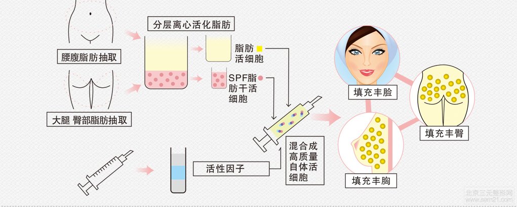 自体脂肪移植示意图