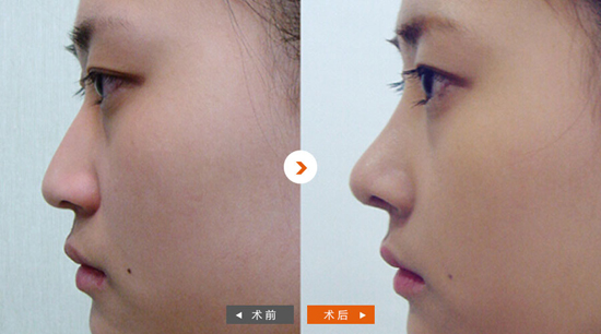 杨明勇隆鼻案例