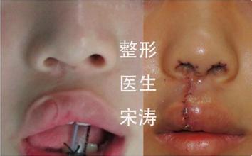 北京八大处整形医院宋涛唇腭裂案例