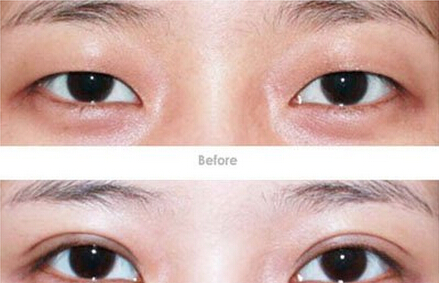 北京八大处王佳琦割双眼皮案例