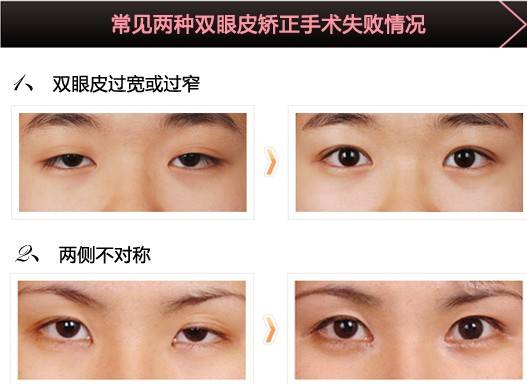 北医三院薛红宇双眼皮修复案例