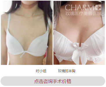 上海玫瑰李鸿君玫瑰弧隆胸案例图 上海玫瑰李鸿君玫瑰弧隆胸案例图
