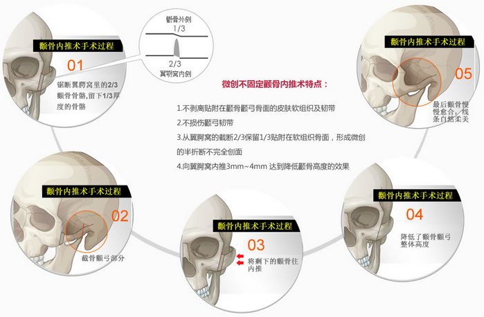 上海名航俞良钢磨颧骨优势 上海名航俞良钢磨颧骨优势