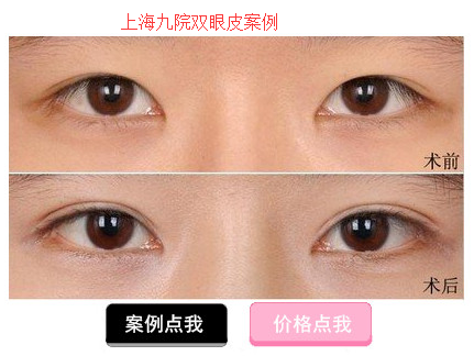 上海九院刘菲双眼皮案例 上海九院刘菲双眼皮案例