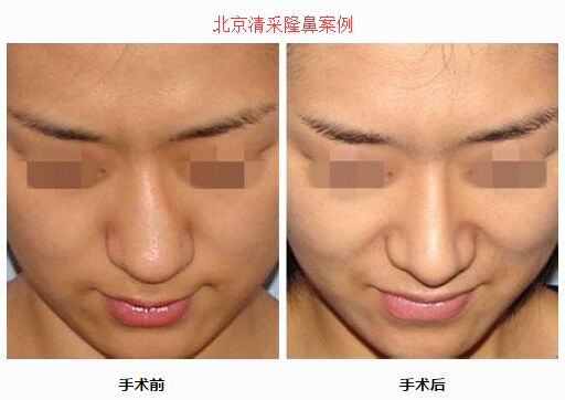 北京俯大赵翊利隆鼻案例 北京俯大赵翊利隆鼻案例