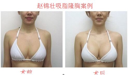 北京俯大赵锦壮吸脂隆胸案例 北京俯大赵锦壮吸脂隆胸案例