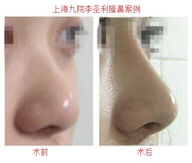 上海九院李圣利隆鼻案例图 上海九院李圣利隆鼻案例图