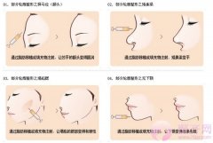 注射完玻尿酸后，应该注意哪些问题？