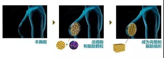 疑问解答:自体脂肪丰胸能不能看出来?
