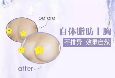 疑问解答:自体脂肪丰胸能不能看出来?