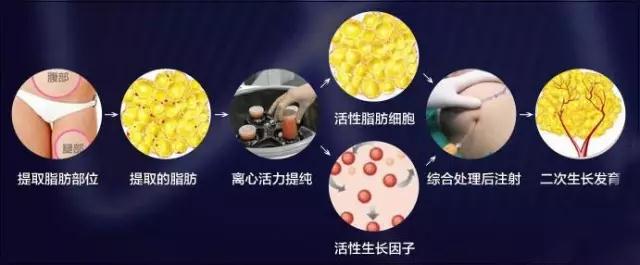 疑问解答:自体脂肪丰胸能不能看出来?