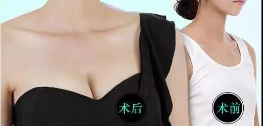疑问解答:自体脂肪丰胸能不能看出来?