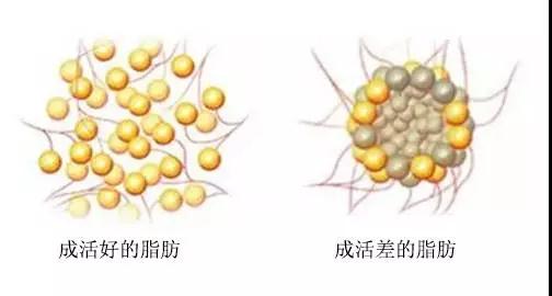 疑问解答:自体脂肪丰胸能不能看出来?