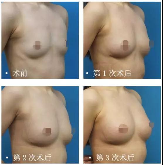 疑问解答:自体脂肪丰胸能不能看出来?