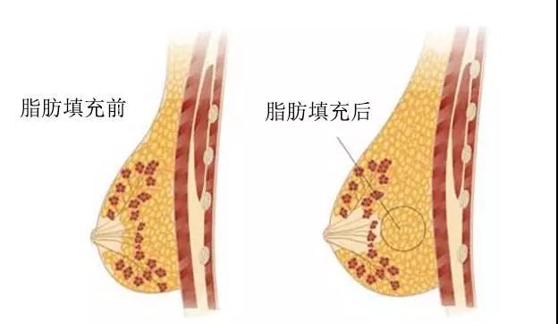 疑问解答:自体脂肪丰胸能不能看出来?