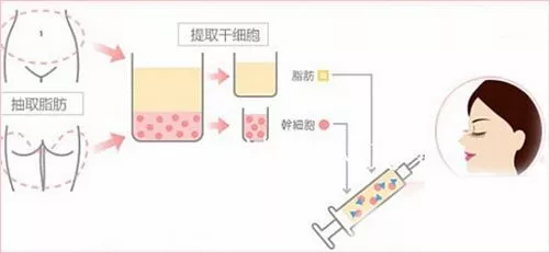 自体脂肪填充能让脸瘦起来!