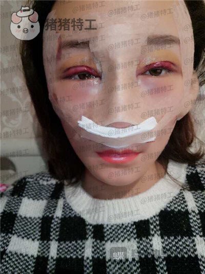 贵阳华美,黄在弘,面部填充,案例,价格,