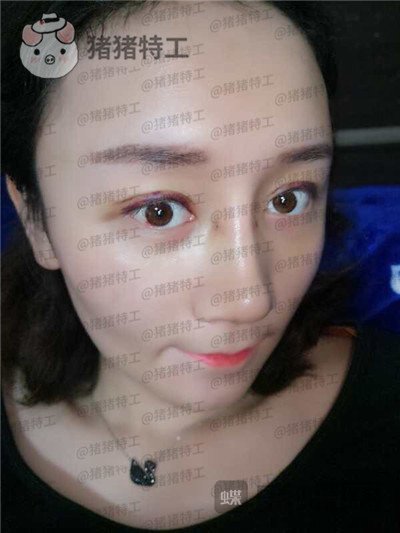 贵阳华美,黄在弘,面部填充,案例,价格,