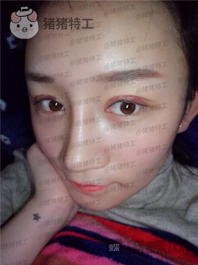 贵阳华美,黄在弘,面部填充,案例,价格,