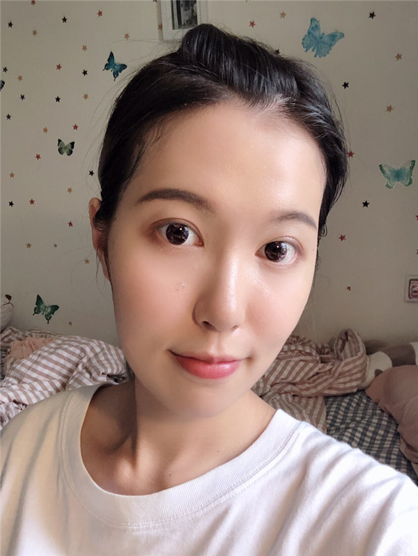 昆明梦想整形李成龙眼部整形怎么样?价格案例