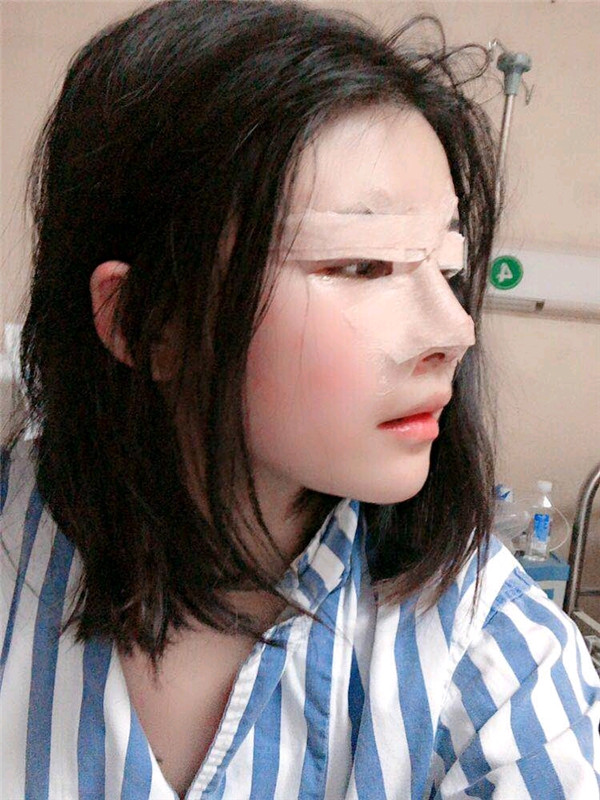 成都西区医院黄富伟鼻部手术怎么样?价格案例