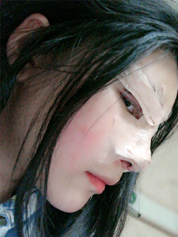 成都西区医院黄富伟鼻部手术怎么样?价格案例