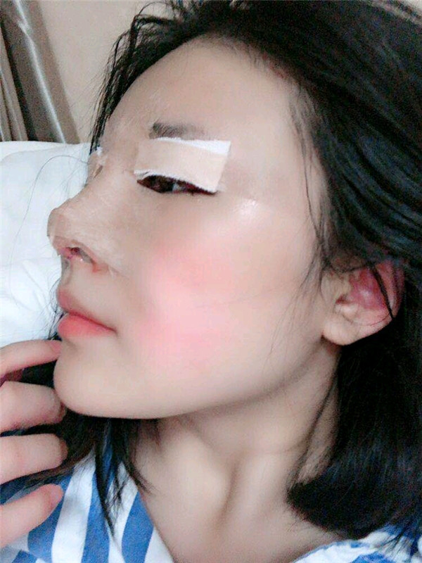 成都西区医院黄富伟鼻部手术怎么样?价格案例